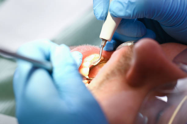 Best Emergency Tooth Extraction in Streator, IL