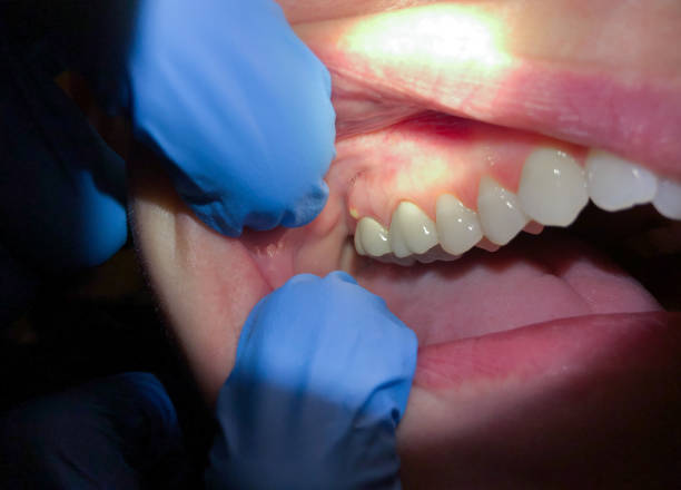 Best Emergency Dental Care for Broken or Chipped Teeth in Streator, IL